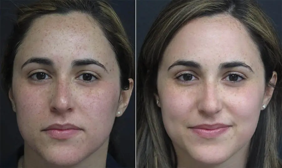 How to Refresh Your Skin During Winter in Surrey, BC