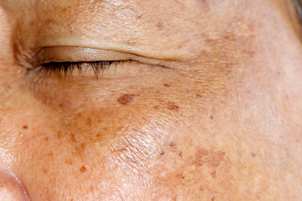 How to Treat Pigmentation and Dark Spots Safely in Surrey, BC